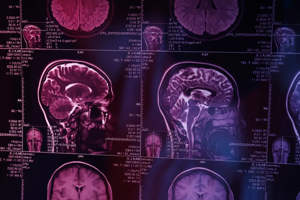 MRI or magnetic resonance imaging of the head and brain